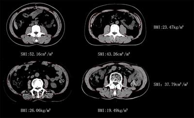 Dynamic changes in body composition during XELOX/SOX chemotherapy in patients with gastric cancer